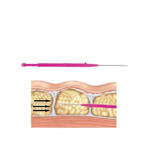 CelluErase (4 Packungen) mikrochirurgische Klingen